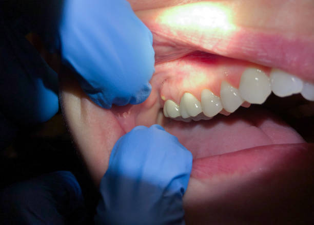 Best Emergency Tooth Extraction in Gaylord, MN